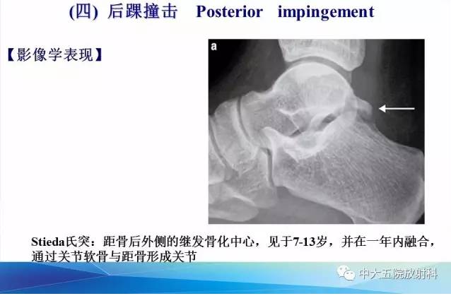 影像PPT - 【PPT】踝关节常见损伤的影像诊断-129