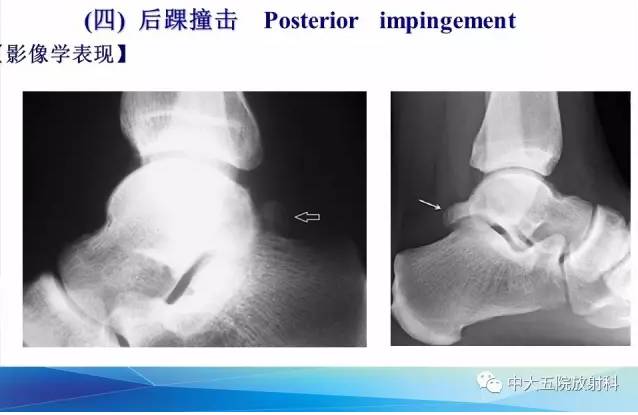 影像PPT - 【PPT】踝关节常见损伤的影像诊断-128
