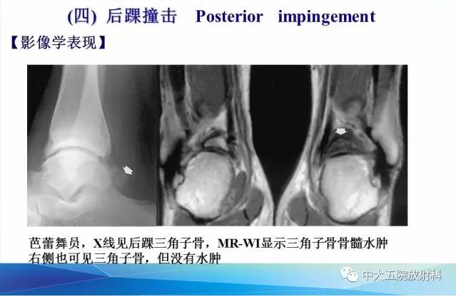 影像PPT - 【PPT】踝关节常见损伤的影像诊断-130