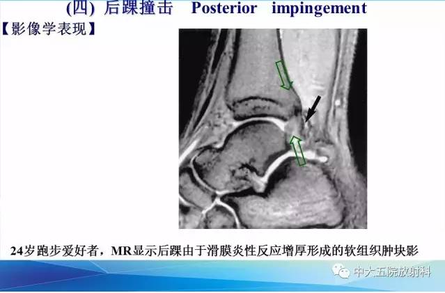 影像PPT - 【PPT】踝关节常见损伤的影像诊断-131