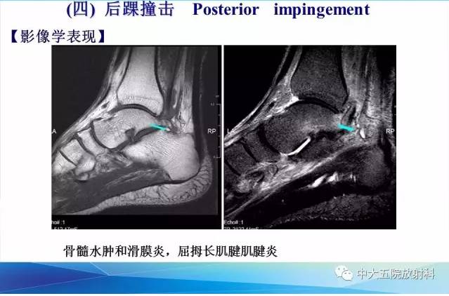 影像PPT - 【PPT】踝关节常见损伤的影像诊断-133