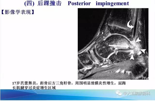 影像PPT - 【PPT】踝关节常见损伤的影像诊断-132