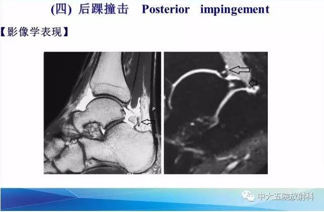 影像PPT - 【PPT】踝关节常见损伤的影像诊断-134