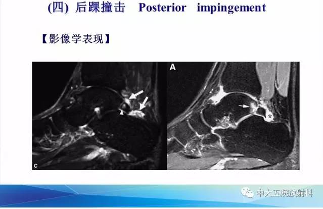 影像PPT - 【PPT】踝关节常见损伤的影像诊断-135