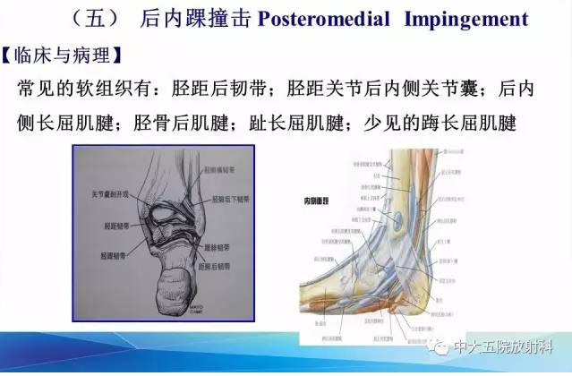 影像PPT - 【PPT】踝关节常见损伤的影像诊断-138