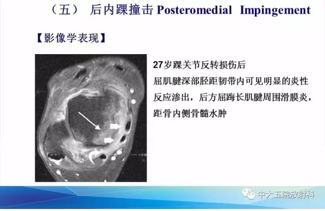 影像PPT - 【PPT】踝关节常见损伤的影像诊断-140