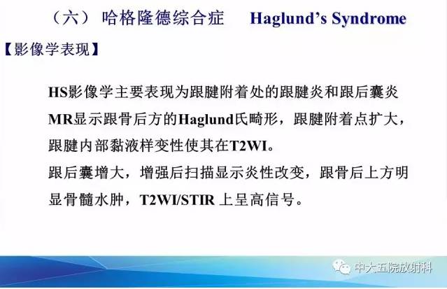 影像PPT - 【PPT】踝关节常见损伤的影像诊断-143