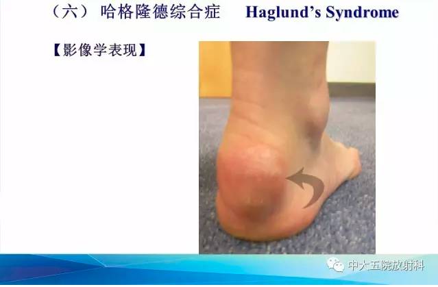 影像PPT - 【PPT】踝关节常见损伤的影像诊断-144