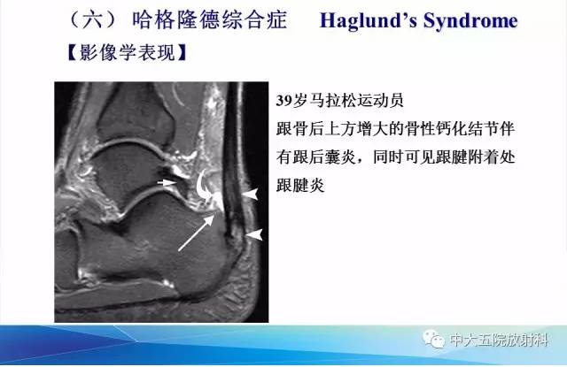影像PPT - 【PPT】踝关节常见损伤的影像诊断-145