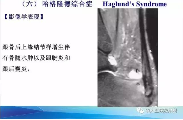 影像PPT - 【PPT】踝关节常见损伤的影像诊断-146