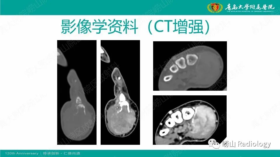 影像PPT - 【病例】掌骨骨巨细胞瘤1例X线CT及MR-6