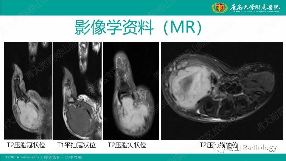 影像PPT - 【病例】掌骨骨巨细胞瘤1例X线CT及MR-7