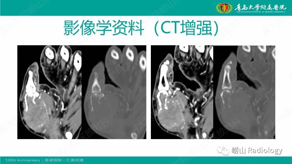 影像PPT - 【病例】掌骨骨巨细胞瘤1例X线CT及MR-5