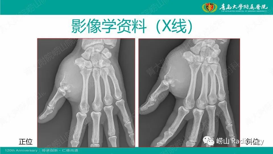 影像PPT - 【病例】掌骨骨巨细胞瘤1例X线CT及MR-3