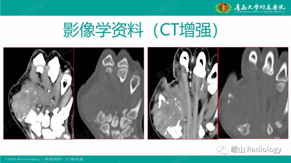 影像PPT - 【病例】掌骨骨巨细胞瘤1例X线CT及MR-4