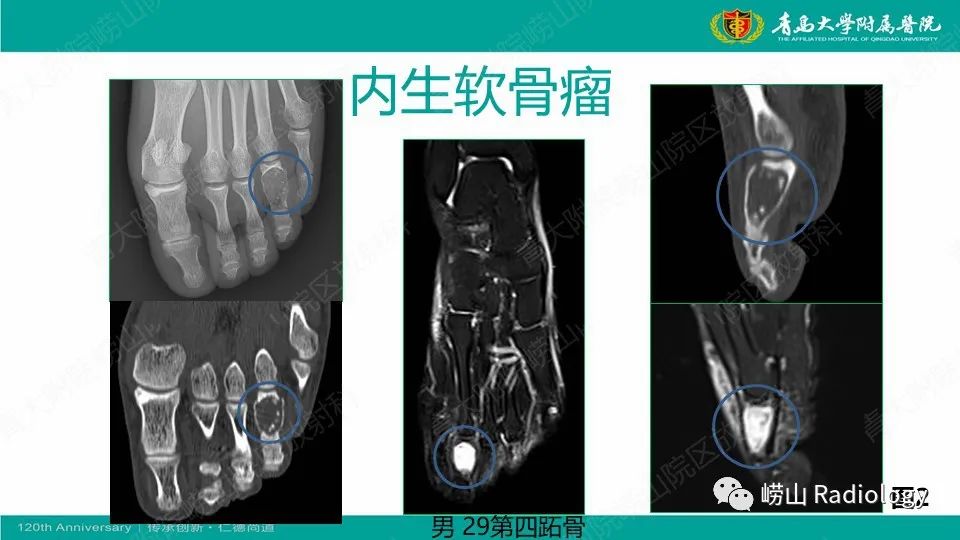 影像PPT - 【病例】掌骨骨巨细胞瘤1例X线CT及MR-19
