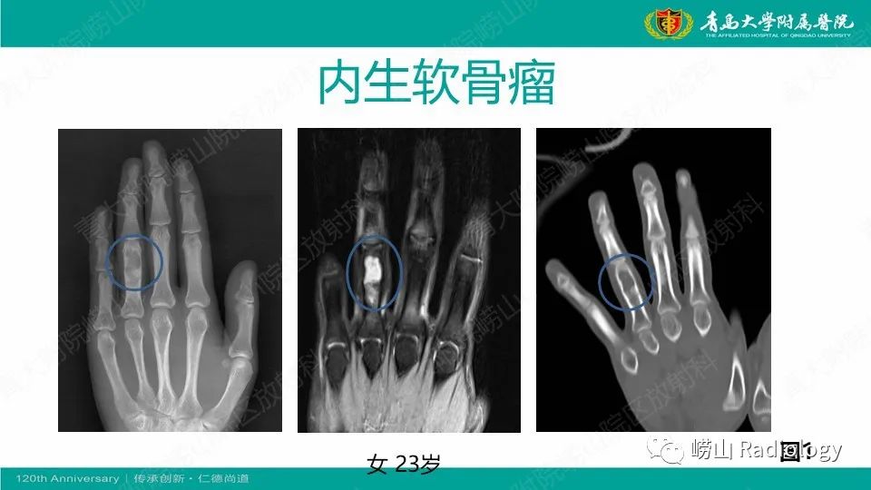 影像PPT - 【病例】掌骨骨巨细胞瘤1例X线CT及MR-18
