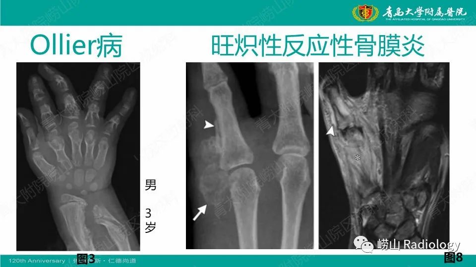 影像PPT - 【病例】掌骨骨巨细胞瘤1例X线CT及MR-20