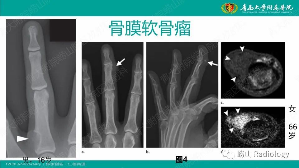 影像PPT - 【病例】掌骨骨巨细胞瘤1例X线CT及MR-21