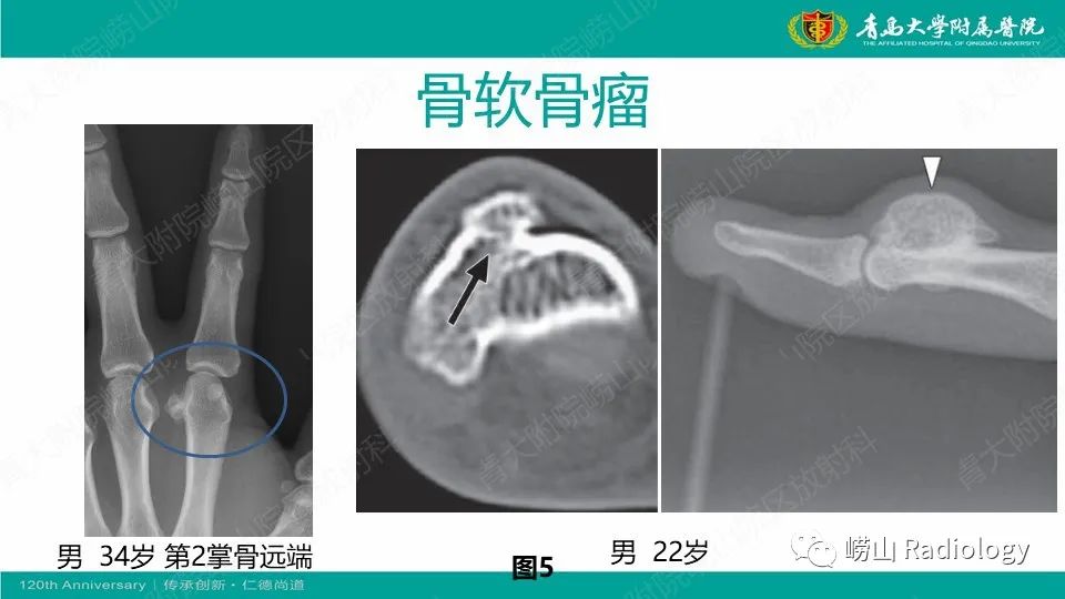 影像PPT - 【病例】掌骨骨巨细胞瘤1例X线CT及MR-22
