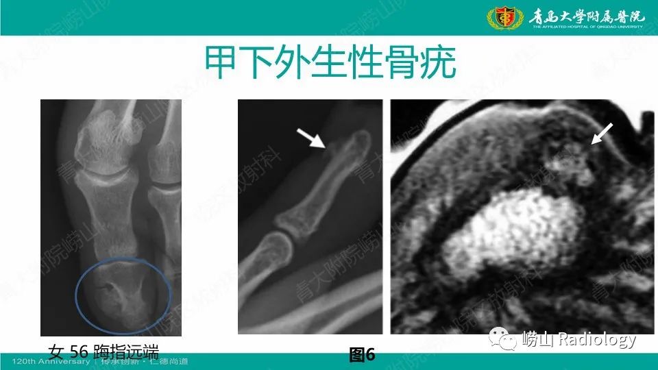 影像PPT - 【病例】掌骨骨巨细胞瘤1例X线CT及MR-23