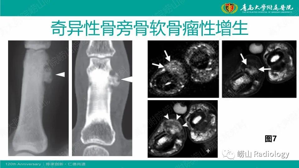 影像PPT - 【病例】掌骨骨巨细胞瘤1例X线CT及MR-24