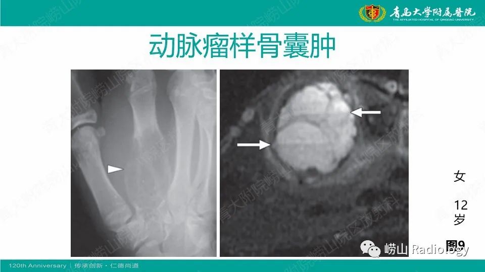 影像PPT - 【病例】掌骨骨巨细胞瘤1例X线CT及MR-25