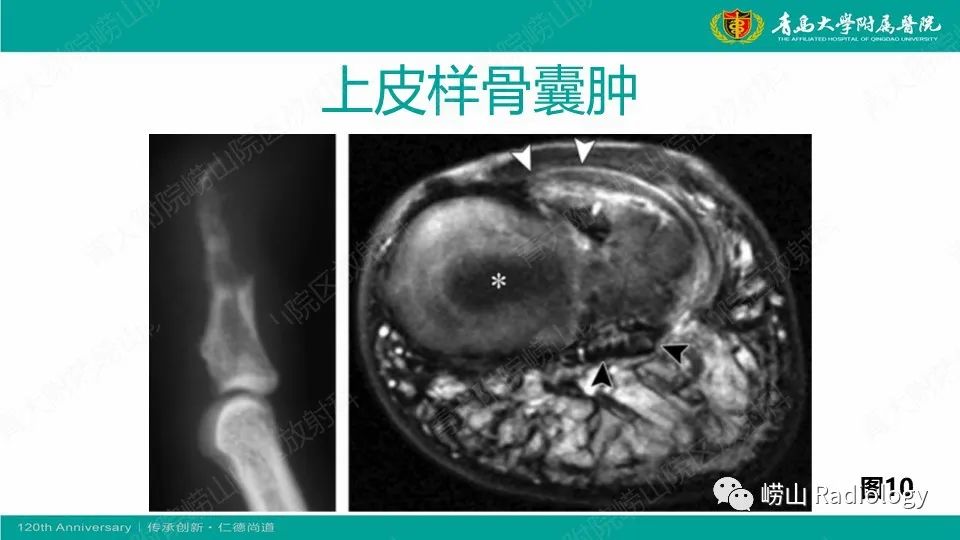 影像PPT - 【病例】掌骨骨巨细胞瘤1例X线CT及MR-26