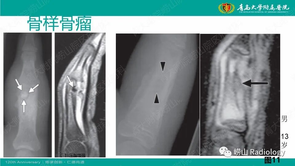 影像PPT - 【病例】掌骨骨巨细胞瘤1例X线CT及MR-27