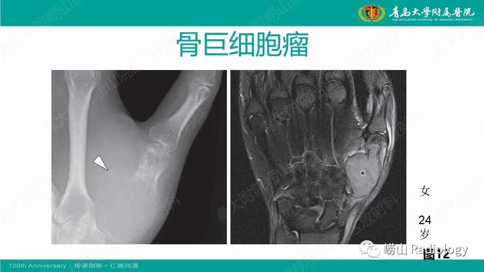 影像PPT - 【病例】掌骨骨巨细胞瘤1例X线CT及MR-28