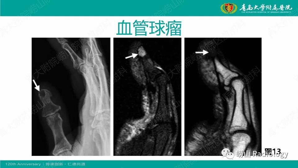 影像PPT - 【病例】掌骨骨巨细胞瘤1例X线CT及MR-29