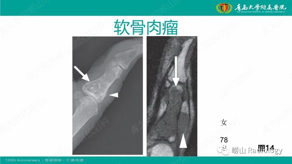 影像PPT - 【病例】掌骨骨巨细胞瘤1例X线CT及MR-30