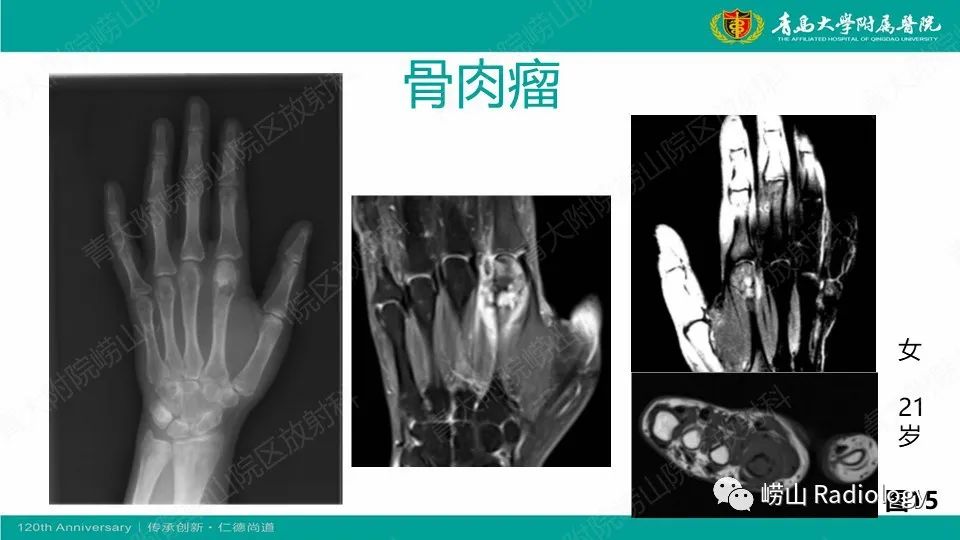 影像PPT - 【病例】掌骨骨巨细胞瘤1例X线CT及MR-31
