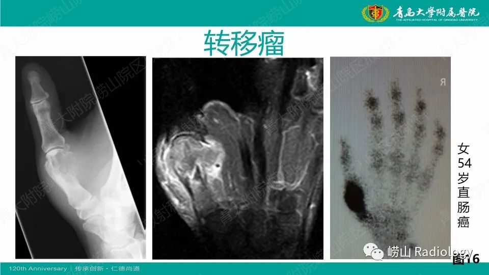 影像PPT - 【病例】掌骨骨巨细胞瘤1例X线CT及MR-32