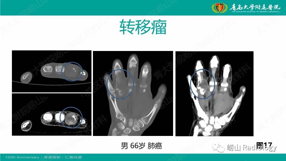影像PPT - 【病例】掌骨骨巨细胞瘤1例X线CT及MR-33
