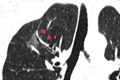 影像PPT - 【病例】早期肺腺癌的3大典型影像特点-3 影像PPT - 【病例】早期肺腺癌的3大典型影像特点-3