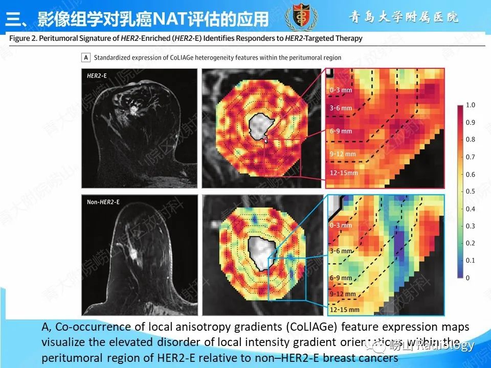 影像PPT - 【PPT】基于影像组学评估乳腺癌新辅助治疗效果-18