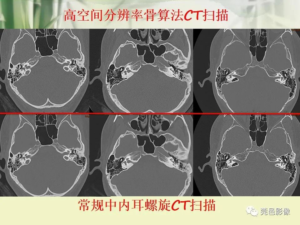 影像PPT - 【PPT】CT高分辨骨算法对中内耳扫描重建技术的探索与总结-3