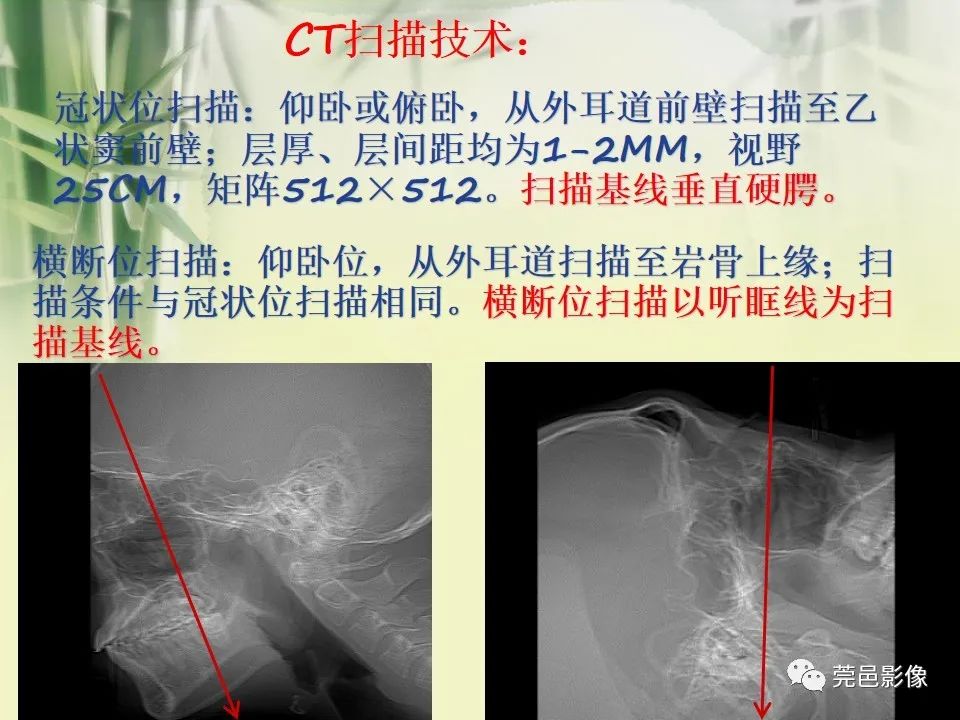 影像PPT - 【PPT】CT高分辨骨算法对中内耳扫描重建技术的探索与总结-6