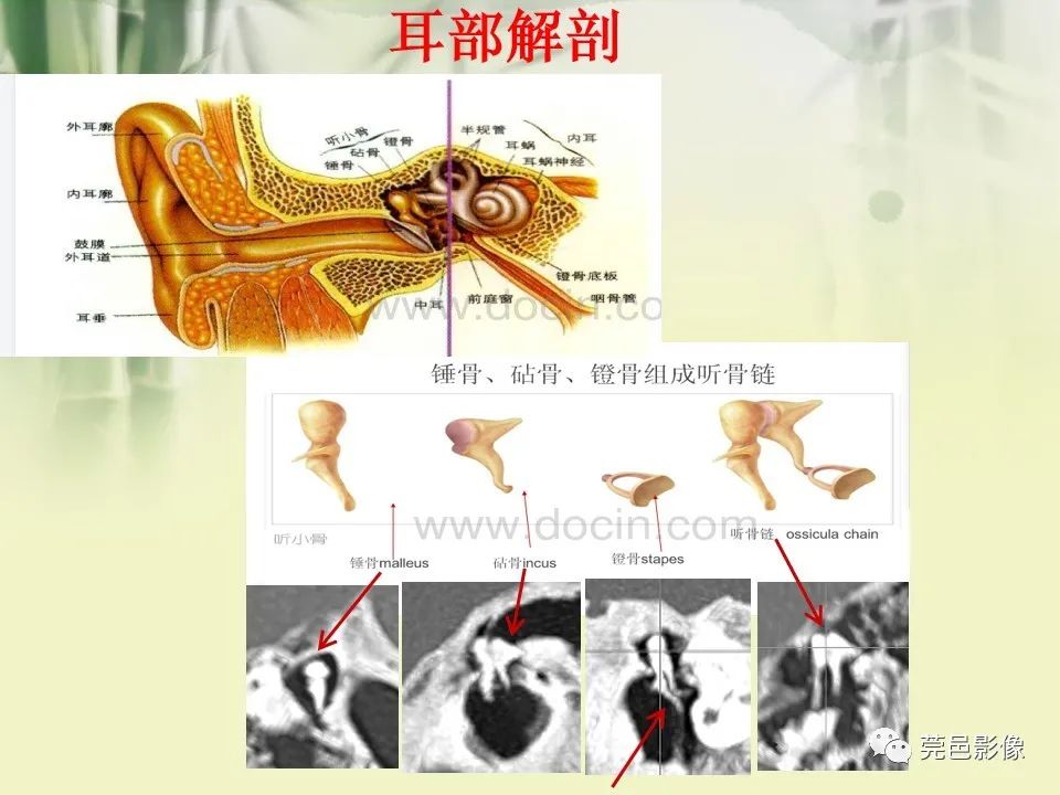 影像PPT - 【PPT】CT高分辨骨算法对中内耳扫描重建技术的探索与总结-7