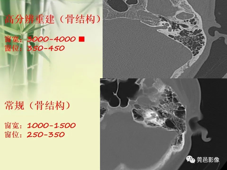 影像PPT - 【PPT】CT高分辨骨算法对中内耳扫描重建技术的探索与总结-10