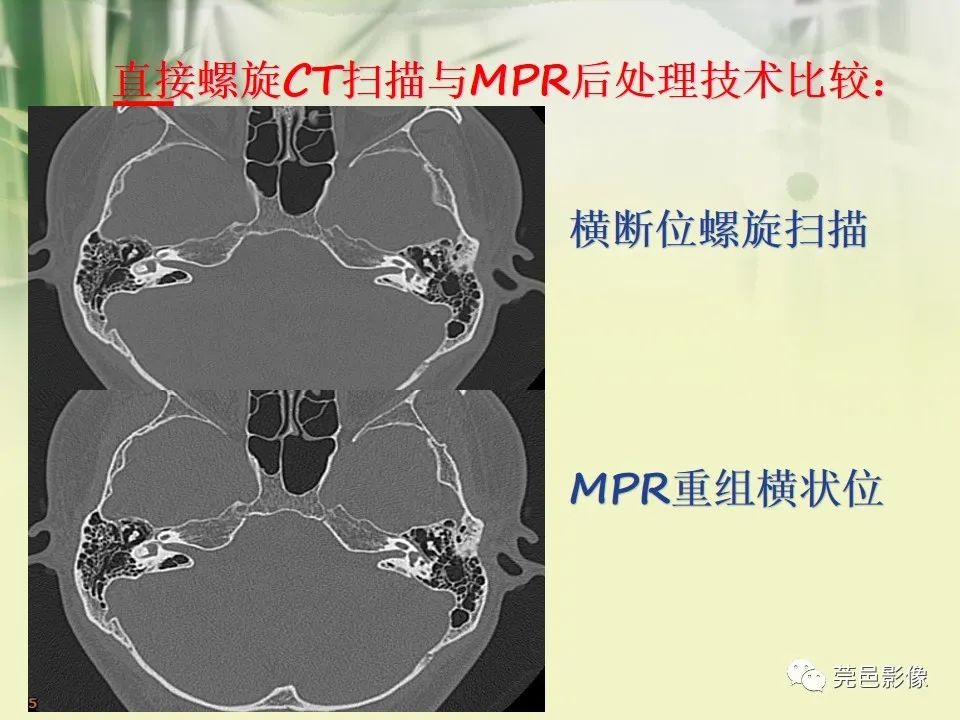 影像PPT - 【PPT】CT高分辨骨算法对中内耳扫描重建技术的探索与总结-8