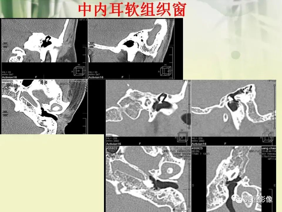 影像PPT - 【PPT】CT高分辨骨算法对中内耳扫描重建技术的探索与总结-11