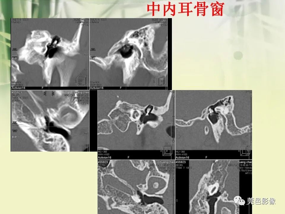 影像PPT - 【PPT】CT高分辨骨算法对中内耳扫描重建技术的探索与总结-12