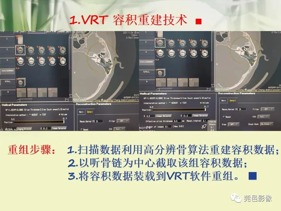 影像PPT - 【PPT】CT高分辨骨算法对中内耳扫描重建技术的探索与总结-13