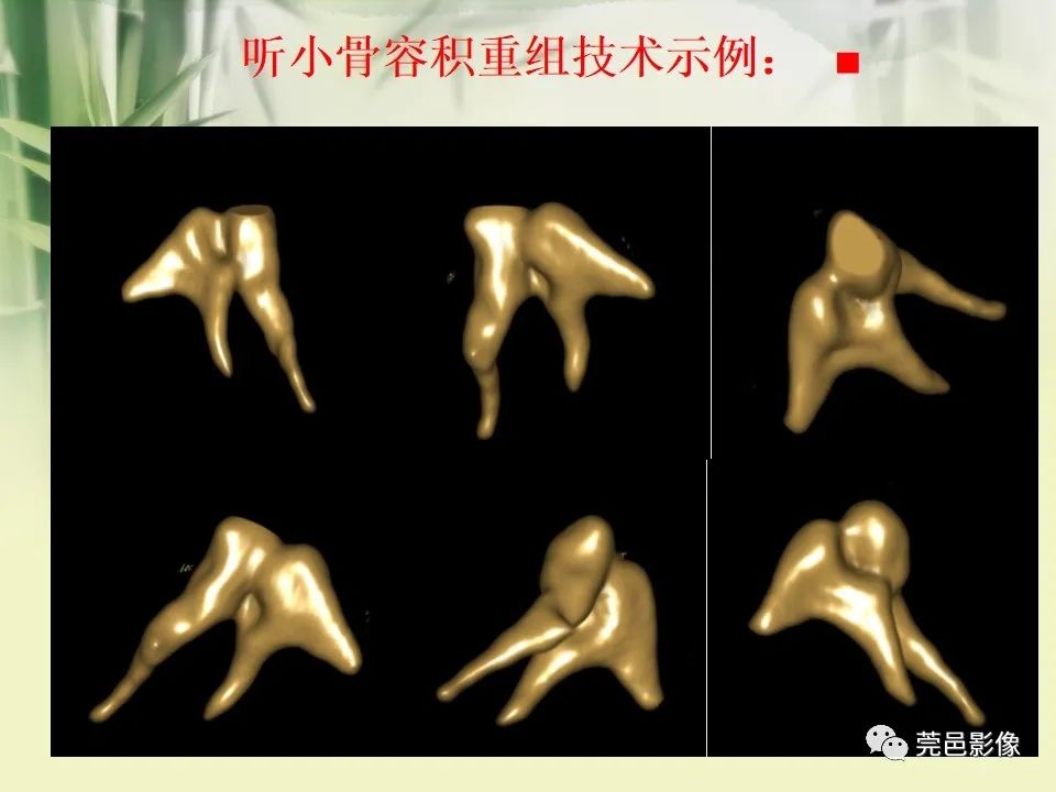 影像PPT - 【PPT】CT高分辨骨算法对中内耳扫描重建技术的探索与总结-14