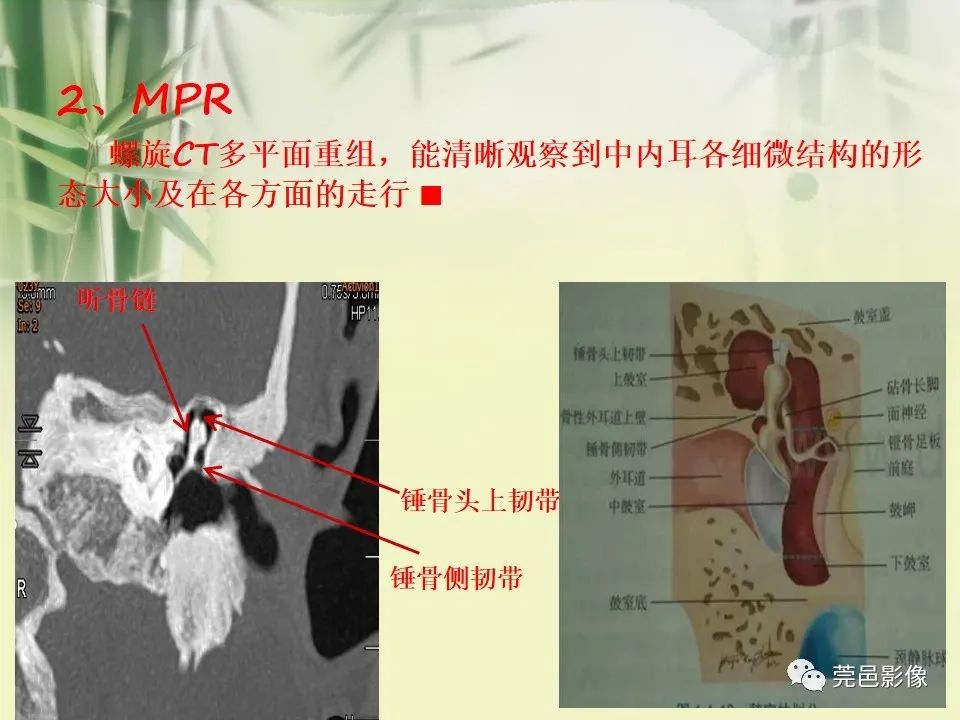 影像PPT - 【PPT】CT高分辨骨算法对中内耳扫描重建技术的探索与总结-17