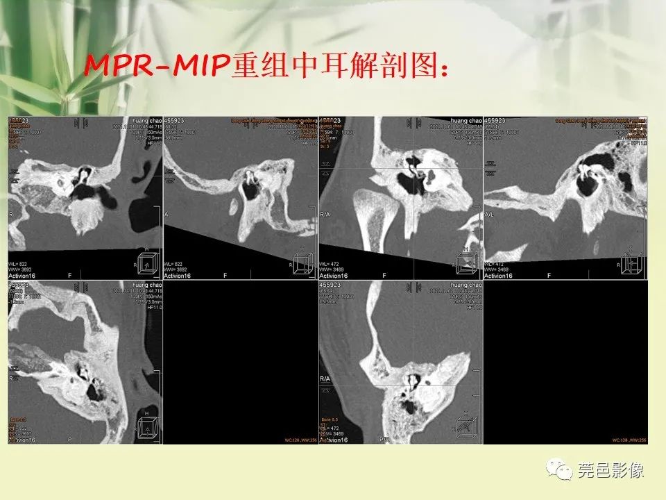 影像PPT - 【PPT】CT高分辨骨算法对中内耳扫描重建技术的探索与总结-18