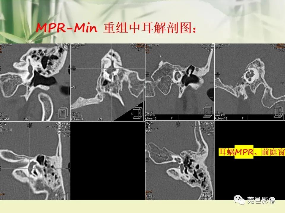 影像PPT - 【PPT】CT高分辨骨算法对中内耳扫描重建技术的探索与总结-19