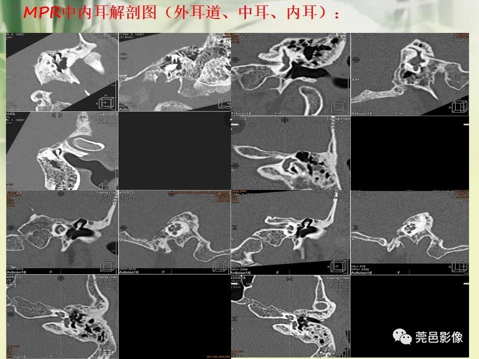 影像PPT - 【PPT】CT高分辨骨算法对中内耳扫描重建技术的探索与总结-20